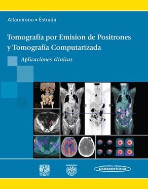 TOMOGRAFA POR EMISIN DE POSITRONES Y TOMOGRAFA COMPUTARIZADA