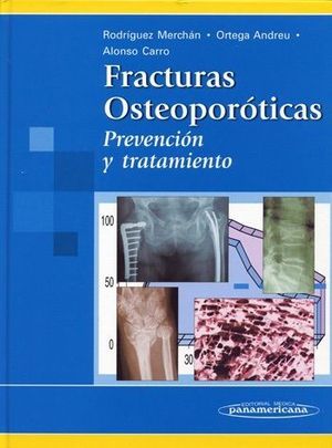 FRACTURAS OSTEOPOROTICAS PREVENCIOIN Y TRATAMIENTO