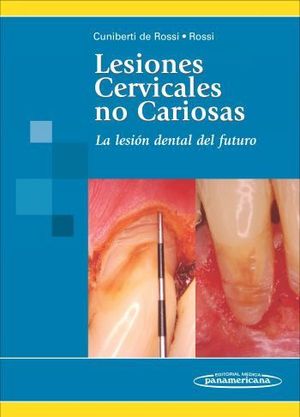 LESIONES CERVICALES NO CARIOSAS